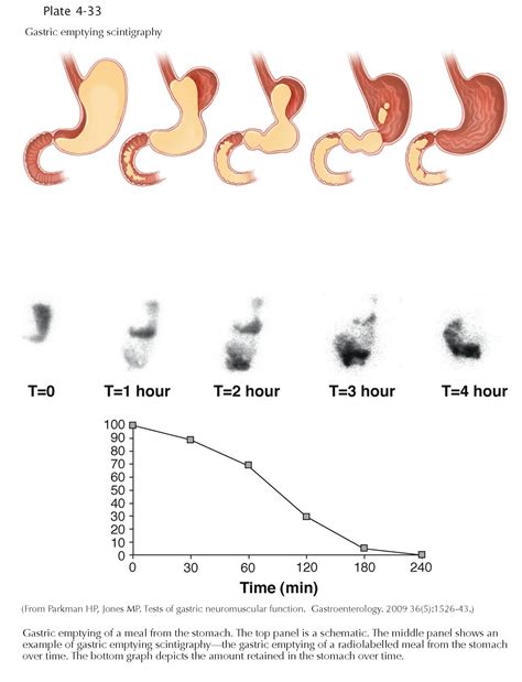DIAGNOSTIC AIDS IN GASTRIC DISORDERS: GASTRIC EMPTYING SCINTIGRAPHY - pediagenosis