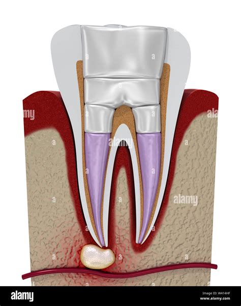 Dental fillings procedure diagramm . 3D illustration Stock Photo - Alamy
