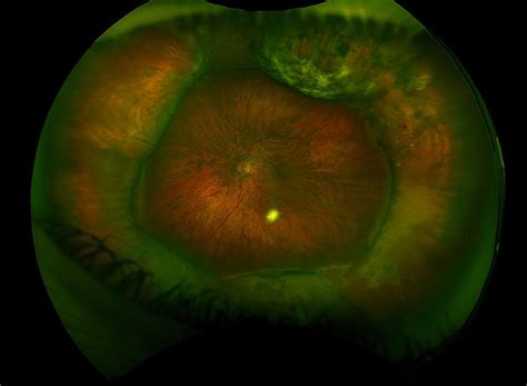 Scleral Buckle Surgery - Retina Center of San Diego