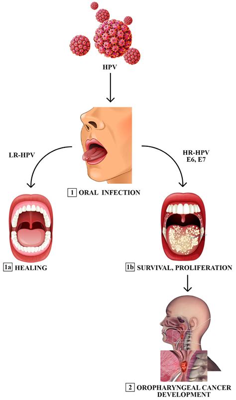 Hpv Infected Throat