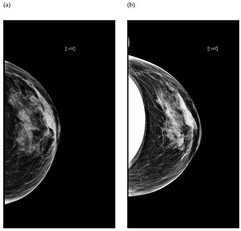 Two-Dimensional Mammography Imaging Techniques for Screening Women with Silicone Breast Implants ...