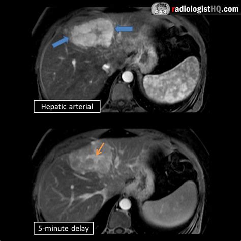 Focal Nodular Hyperplasia Liver