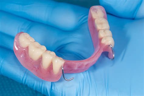 Fixed Partial Denture Bridge