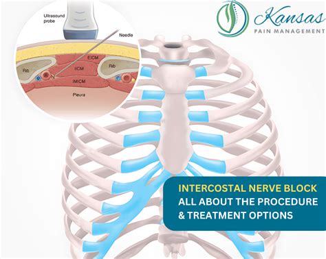 Is Intercostal Neuralgia Permanent – BYOFB