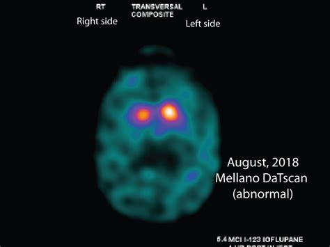 Image result for Dat Scan Utube