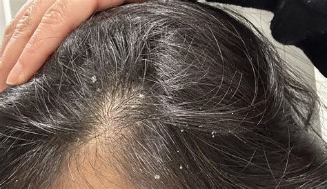 Dandruff Flakes In Hair