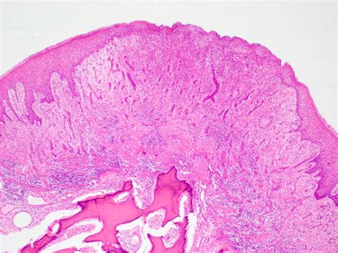 Peripheral Ossifying Fibroma Histology