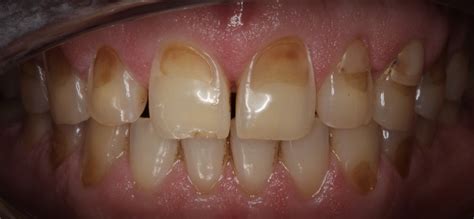 What Causes Acid Erosion of Enamel | Smile Kyle | NEO Dentistry
