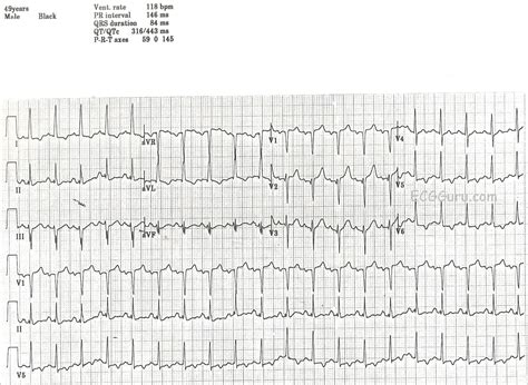 Pathological Q waves | ECG Guru - Instructor Resources
