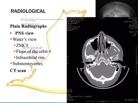 Management of zygomaticomaxillary complex fractures ih | PPTX