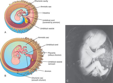 The Umbilical Cord - Clinical Tree