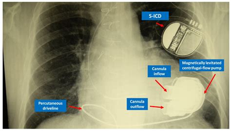 Hyoid Bone Syndrome in a Patient Undergoing Left Ventricular Assist ...