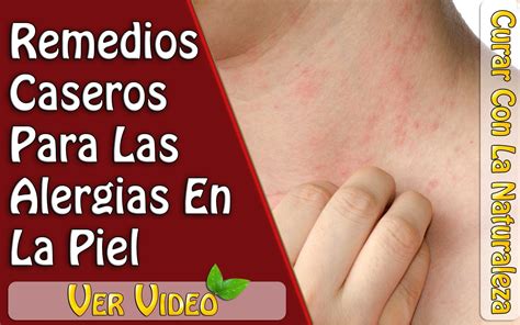 3 REMEDIOS CASEROS PARA LAS ALERGIAS EN LA PIEL COMO CURAR ALERGIAS EN LA PIEL | Alergia piel ...