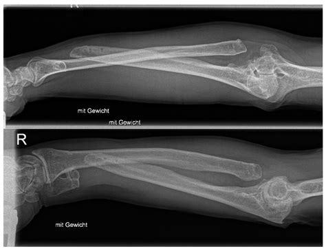 Missed Essex-Lopresti Injury—Development of a Combined Proximal and Distal Radio-Ulnar Joint ...