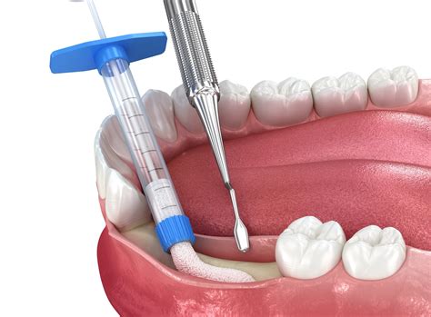 Four Types of Dental Bone Grafts | Magnolia Family Dental | Alvin, TX
