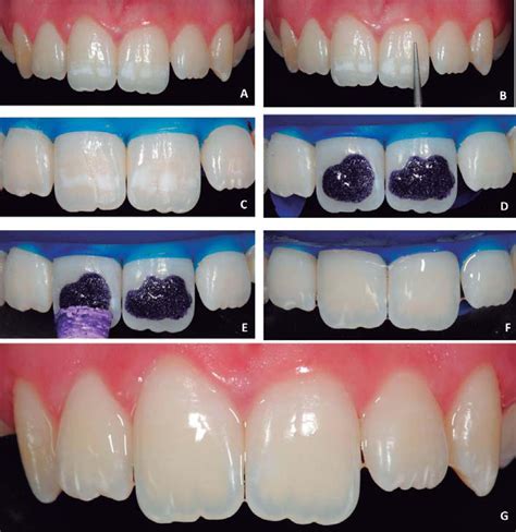 Microabrasion in tooth enamel discoloration defects three cases with long term follow ups – Artofit