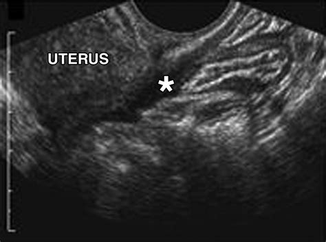 Endometriosis of the Posterior Cul-De-Sac: Clinical Presentation and ...