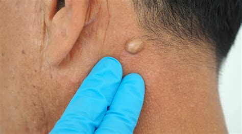 Sebaceous Cyst: Causes, Symptoms, and Effective Treatments