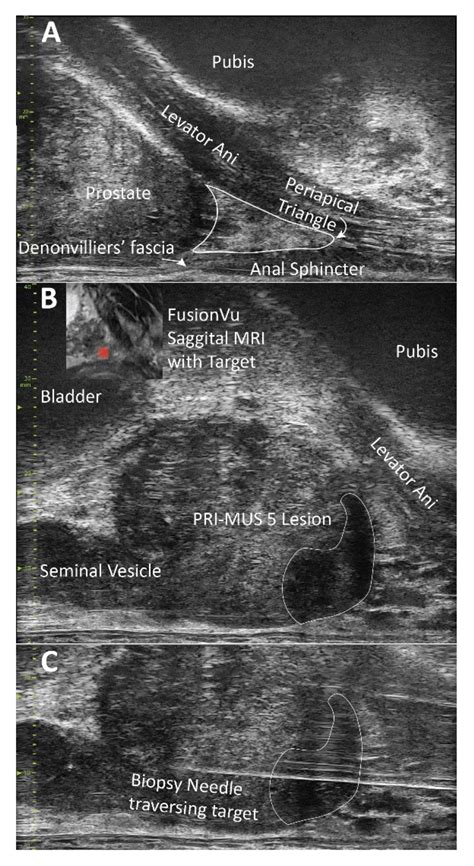 Micro-Ultrasound Guided Transperineal Prostate Biopsy: A Clinic-Based Procedure | Protocol
