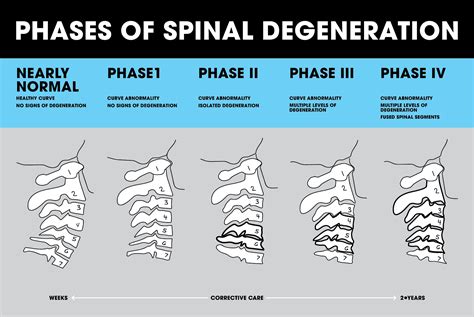 Deteriorating Spinal Discs at Christopher Foss blog