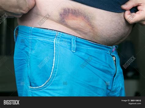 Bruise, Hematoma On Image & Photo (Free Trial) | Bigstock