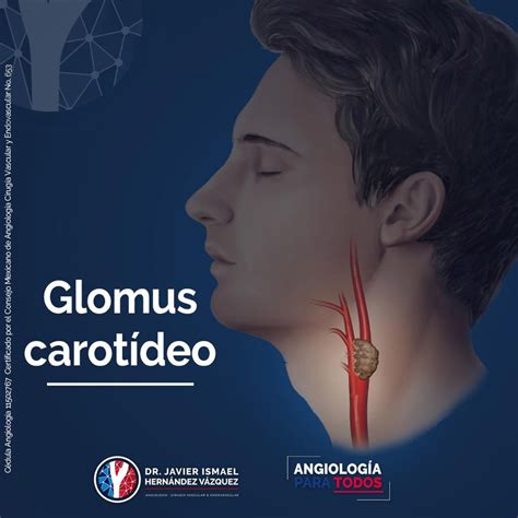 Tumores de cuerpo carotídeo - Dr. Javier Hernández