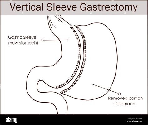 Vector illustration of Vertical Sleeve Gastrectomy Stock Vector Image & Art - Alamy