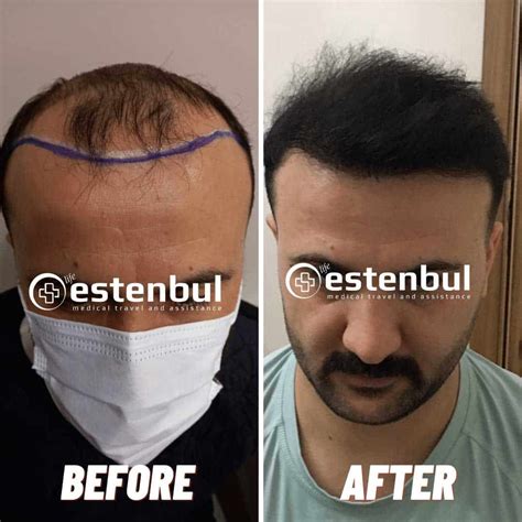 Hair Transplant Istanbul Turkey