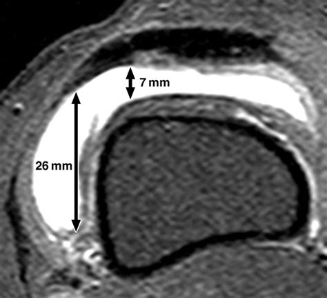 Accuracy of Cross-Table Lateral Knee Radiography for Evaluation of Joint Effusions | AJR