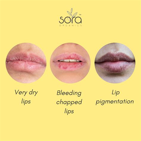 Chapped Lips Before And After