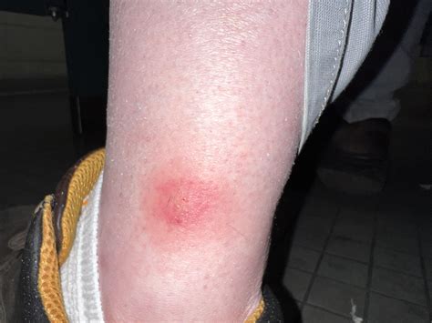 HELP. Spider bite or no? : r/spiderbites