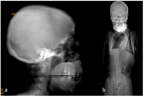 Meticulous and Early Understanding of Congenital Cranial Defects Can ...