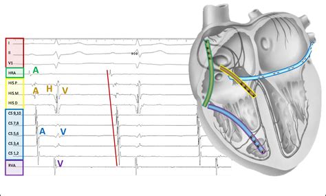 EP 101 - More Signals & Catheters - EP Essentials
