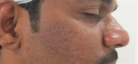 Acne Scar Removal In Bengali : Top Dermatologists For Pimple Marks