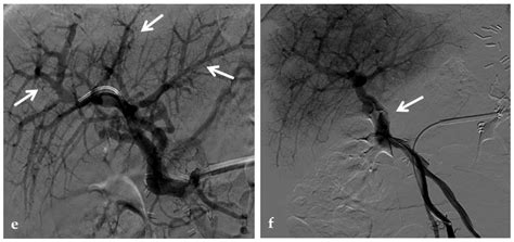 The Role of Imaging in Portal Vein Thrombosis: From the Diagnosis to ...
