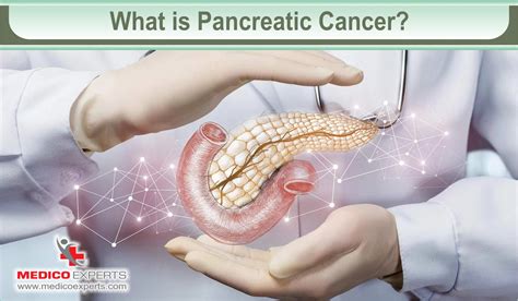Early Sign Of Pancreatic Cancer - Infoupdate.org