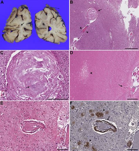 Charcot–Bouchard aneurysms revisited: clinicopathologic correlations - Modern Pathology