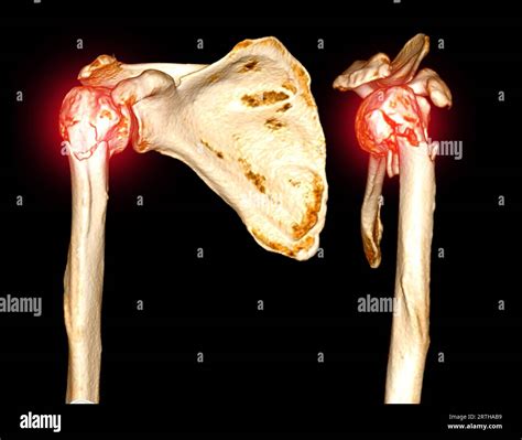 CT scan 3D rendering of shoulder joint showing fracture head of humerus ...