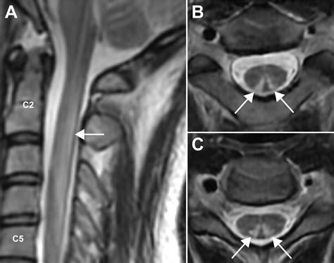 “Inverted V” sign in subacute combined degeneration of the spinal cord after recreational use of ...