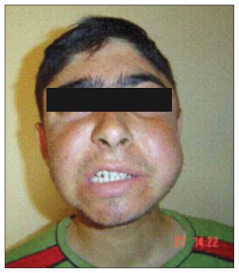 Melkersson-Rosenthal syndrome with partial oculomotor nerve palsy | Annals of Saudi Medicine