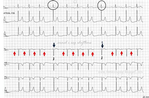 Junctional Escape Rhythm Strip