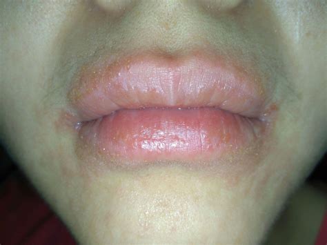 【嘴唇周围长痘痘是什么原因】【图】嘴唇周围长痘痘是什么原因？ 4个根因提醒你们(2)_伊秀健康|yxlady.com