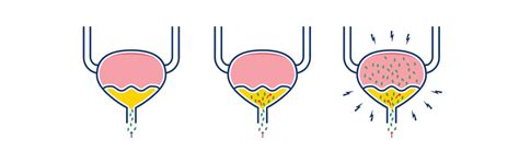 Urinary Tract Infection – UTI – TENA