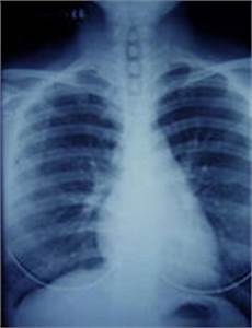mesothelioma lung cancer asbestos victims center 800 mesothelioma victims center the premier mesothelioma mesothelioma lung cancer asbestos victims center 800 mesothelioma victims center the premier mesothelioma