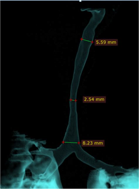 Sliding tracheoplasty of complete tracheal cartilage rings in children ...