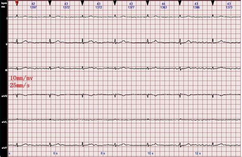 心电图图例分析：心房颤动、三度房室传导阻滞、交界性逸搏心律 - 爱爱医医学网