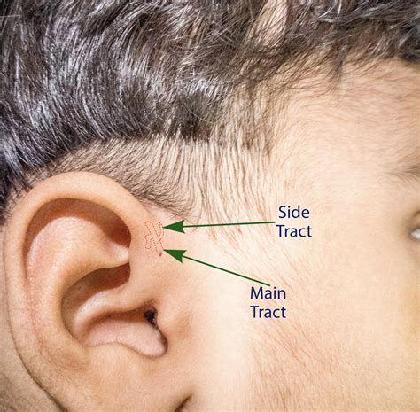 Sinus Behind Ear