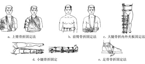 小孩胳膊骨折畸形图,小孩手臂骨折图片_大山谷图库