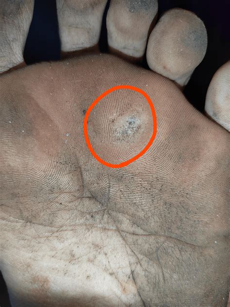 Wart or callus? : r/DermatologyQuestions
