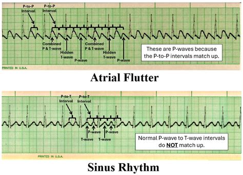 EKG Detective: Atrial flutter